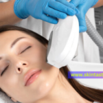 IPL treatment in Riverside