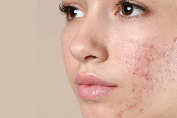 Acne Prone Skin