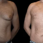 male with breast reduction