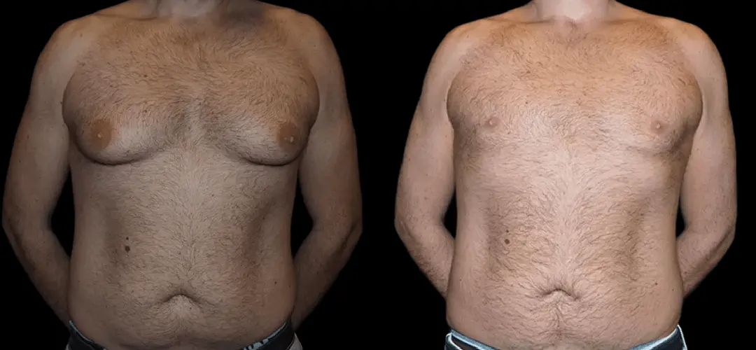male with breast reduction