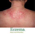 Eczema