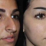  Redefining Profiles: Your Essential Rhinoplasty in Dubai Handbook