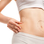 Liposuction Abu Dhabi